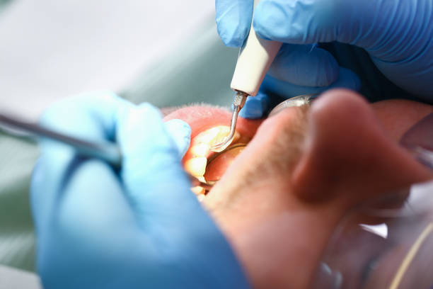 Best Emergency Tooth Extraction in Poquoson, VA
