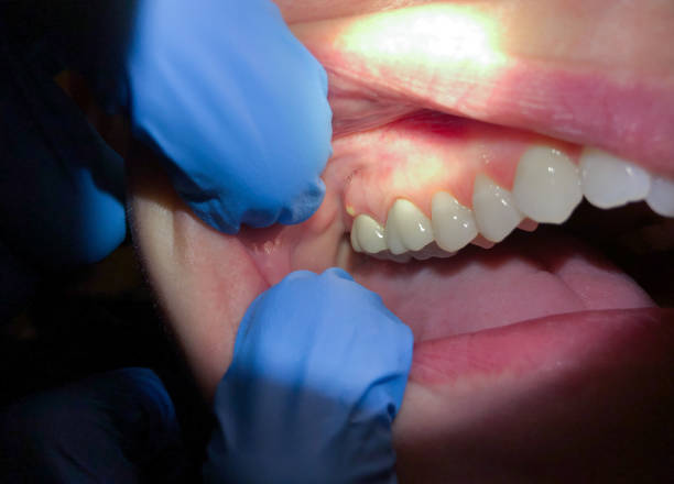 Best Emergency Gum Treatment in Poquoson, VA