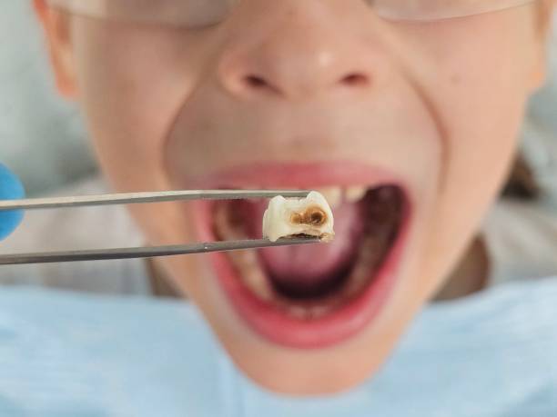 Best Emergency Treatment for Dental Infections or Abscesses in Poquoson, VA